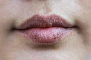 Dehydrated Lips