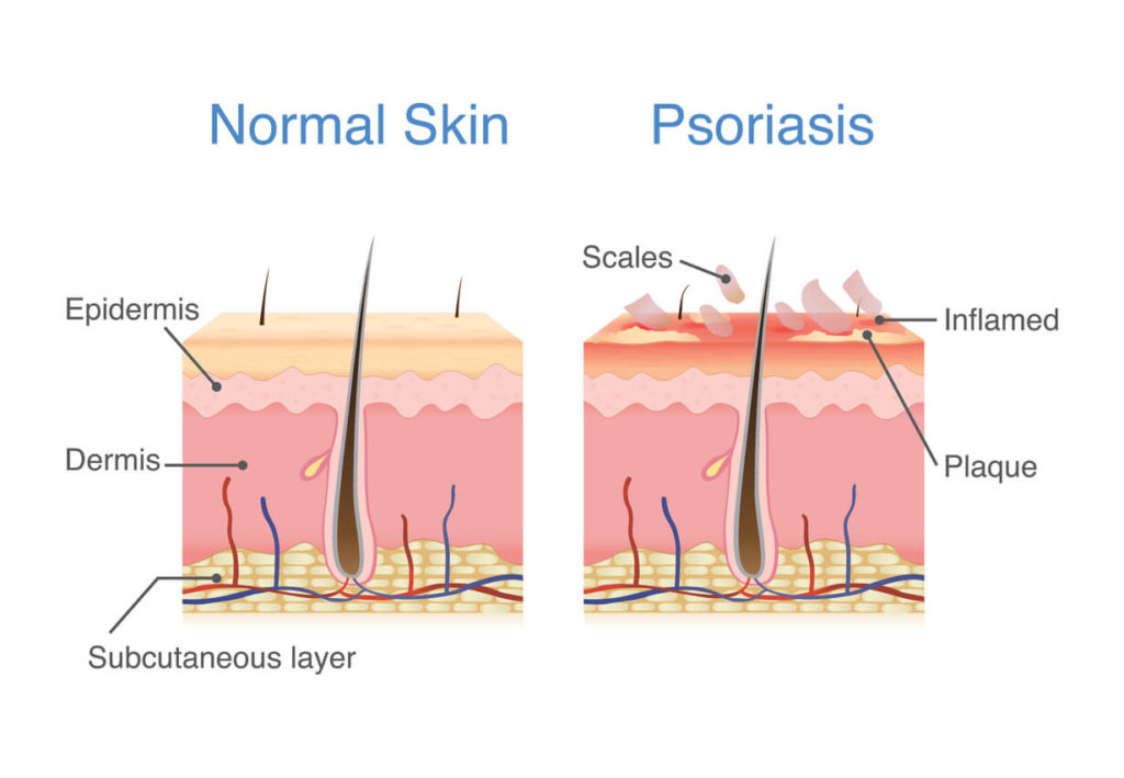 Illustration of normal skin layers versus psoriasis