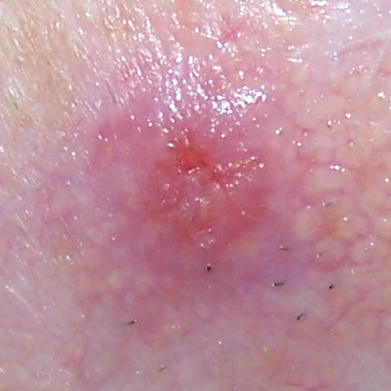 Squamous Cell Carcinoma 1