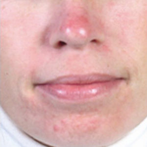 Face showing redness from environmental stressors