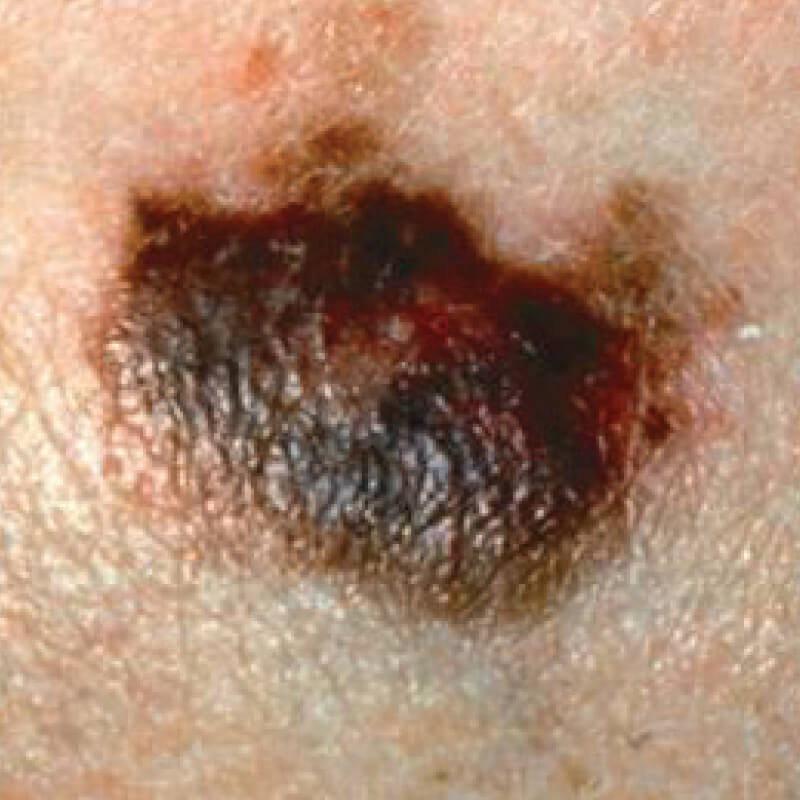 ABCDEs of Melanoma - Color