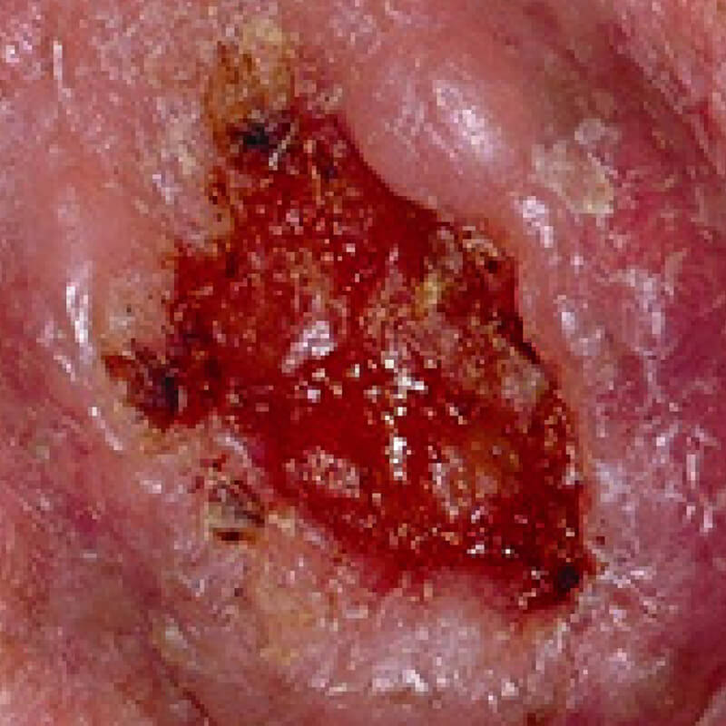 Squamous Cell Carcinoma 2