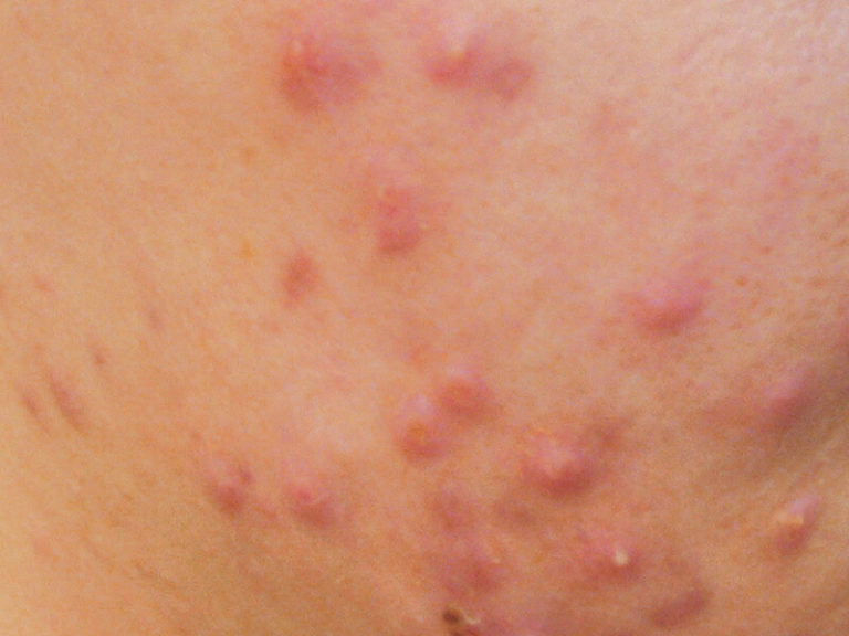 Acne - pcaskinacademy.com - pcaskinacademy.com