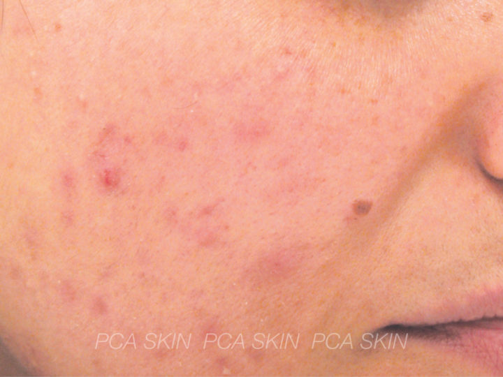 Adolescent Acne - After