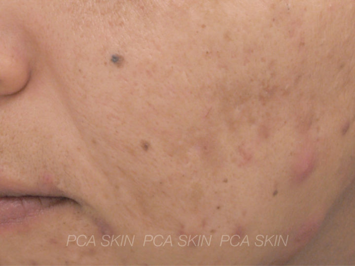 Adult Acne - Before